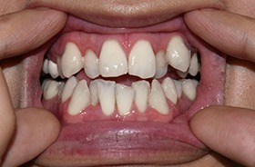 Close-up of person’s crowded, overlapping teeth