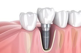 Digital image of dental implant between natural teeth